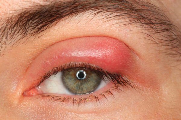 CUIDAR LA PIEL DEL ROSTRO OJO IRRITADO